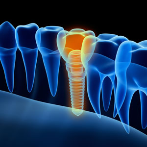 Illustration of dental implant