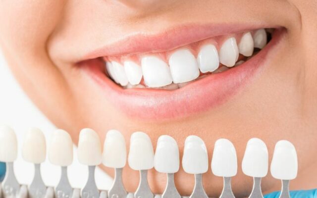 Alt: What is Veneer Composite?