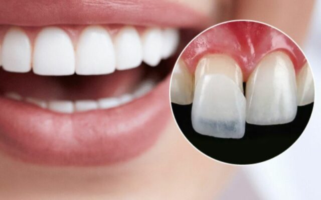 Alt: Porcelain Veneer ensures high translucency while providing good coverage