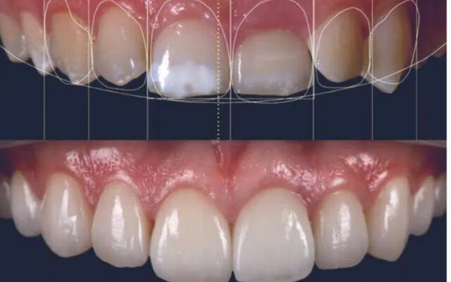 Alt: The Porcelain Veneer method is an excellent option for those looking to enhance the appearance of their teeth.